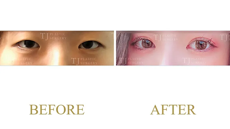 Plastic Surgery Case 11 — Case 11