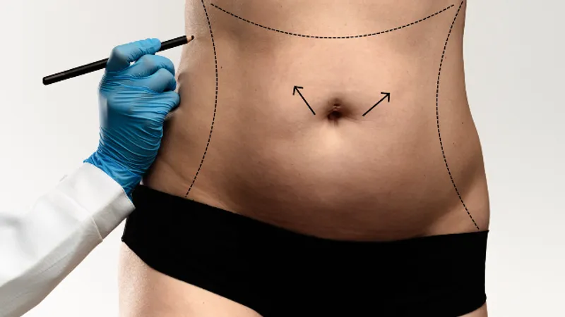 Mommy Makeover in Korea: Body Contouring After Pregnancy