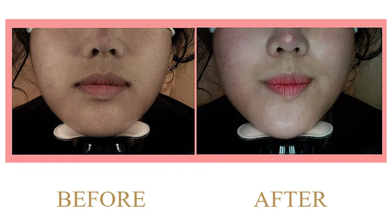 Lower Face and Jawline Improvement (3 Months Post-Treatment)
