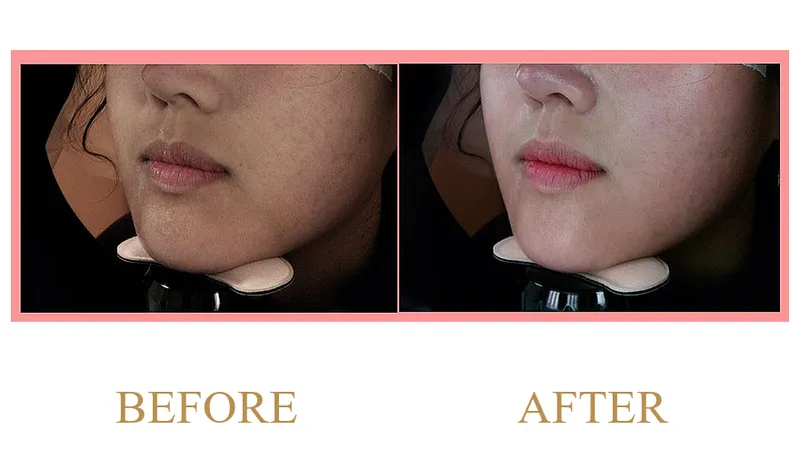 Lower Face and Jawline Contouring Case (3 Months Post-Treatment)