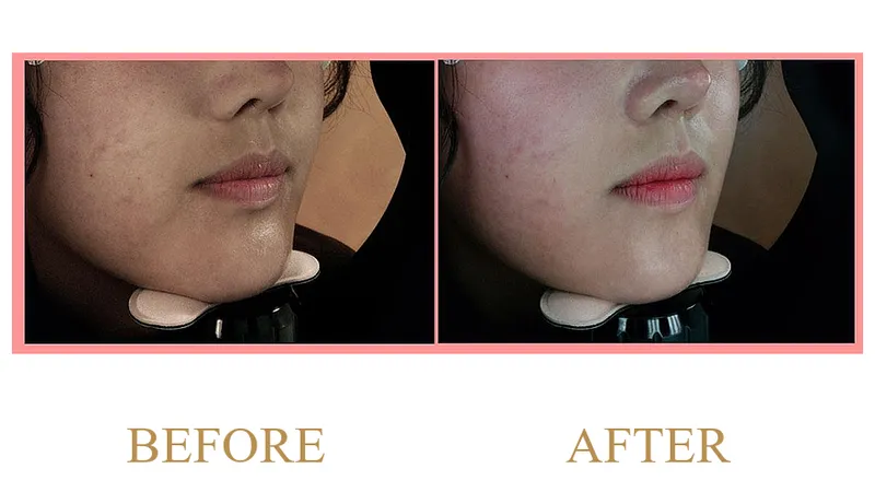 Double Chin and Lower Facial Contour Improvement (3 Months Post-Treatment)