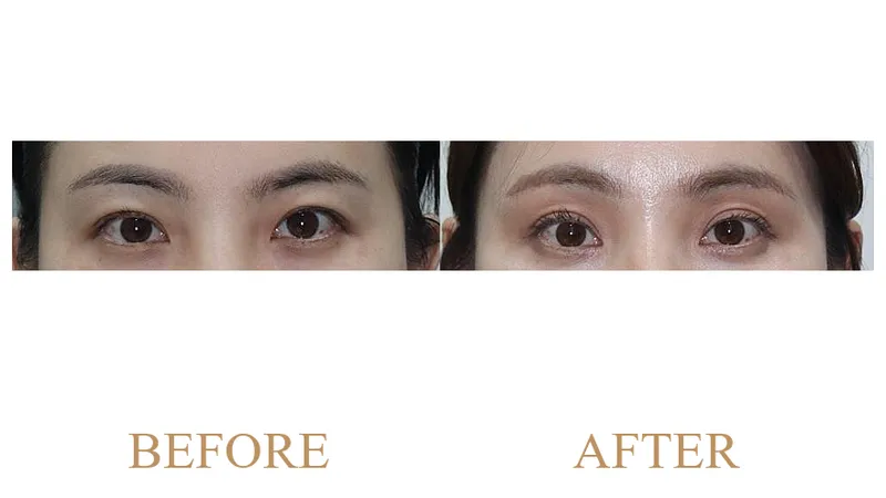 Endoscopic Forehead Lift + Sub-Brow Lift