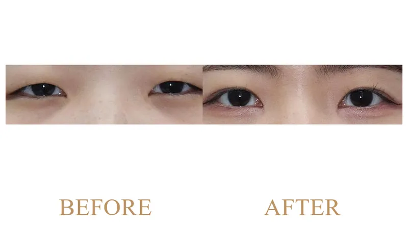 Incisional Double Eyelid Surgery + Ptosis Correction + Medial Epicanthoplasty