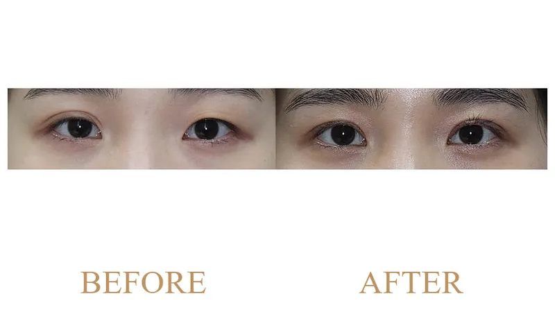 Incisional Double Eyelid Surgery + Ptosis Correction + Upper Epicanthoplasty