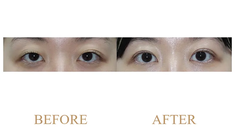 Incisional Double Eyelid Surgery + Ptosis Correction + Upper Epicanthoplasty