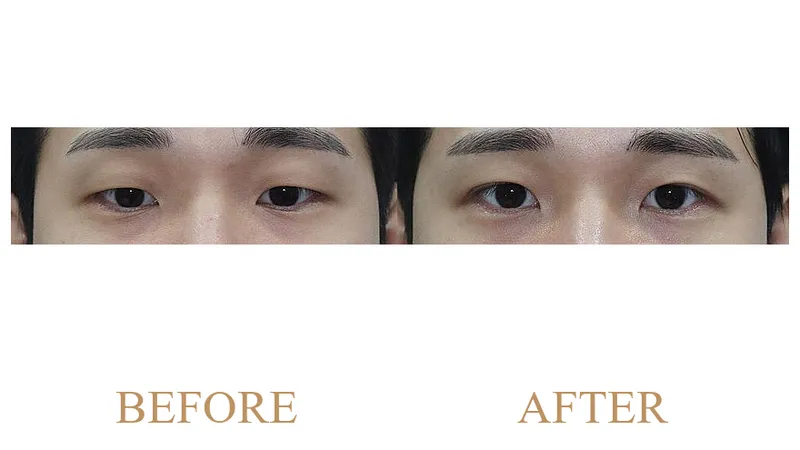 Incisional Double Eyelid Surgery + Ptosis Correction + Upper Eyelid Opening