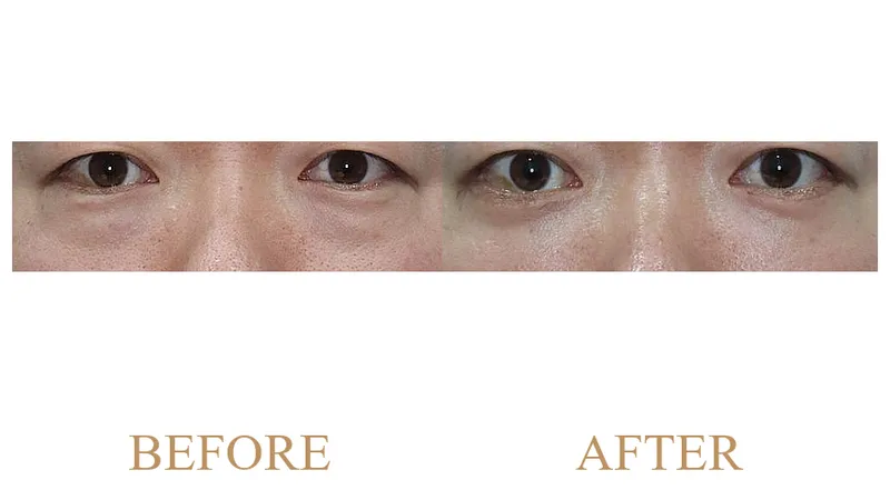 Lower Blepharoplasty + Super Lift + Lateral Canthoplasty