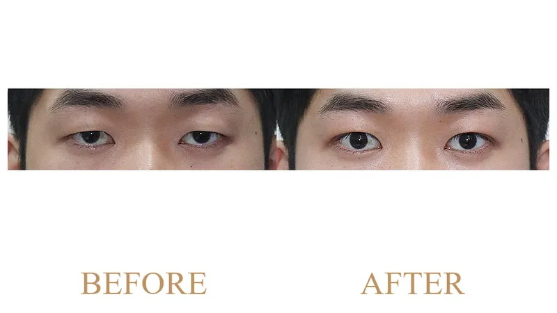 Minimal Incision Double Eyelid Surgery + Ptosis Correction