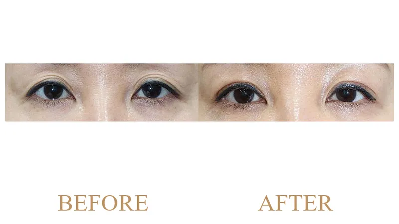 Natural Adhesion Upper Blepharoplasty + Ptosis Correction + Under-Eye Fat Filler