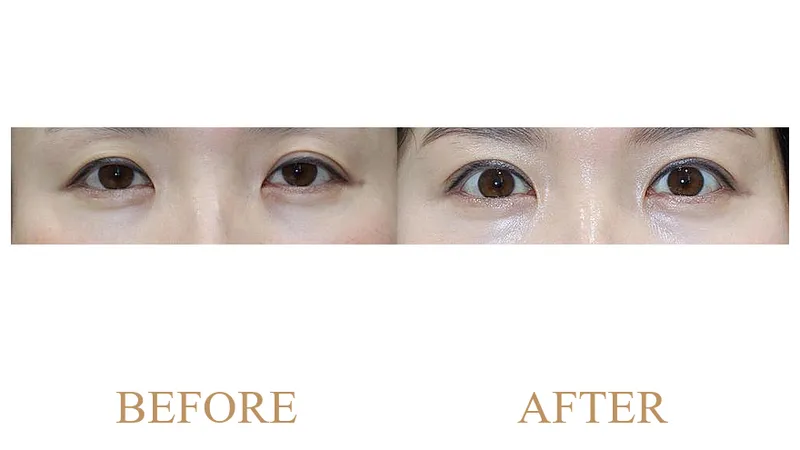 Natural Adhesion Upper Blepharoplasty + Ptosis Correction + Upper Epicanthoplasty