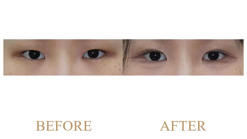 Partial Incisional Double Eyelid Surgery + Ptosis Correction + Medial Epicanthoplasty