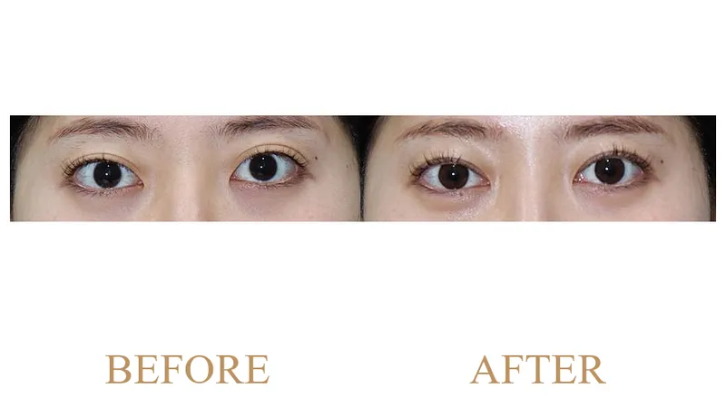 Partial Incisional Double Eyelid Surgery + Ptosis Correction + Upper Epicanthoplasty
