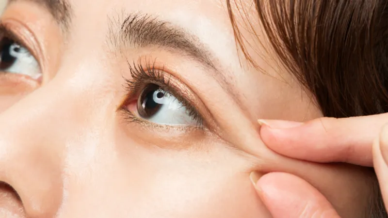 Revision Double Eyelid Surgery: A Full Procedure Guide