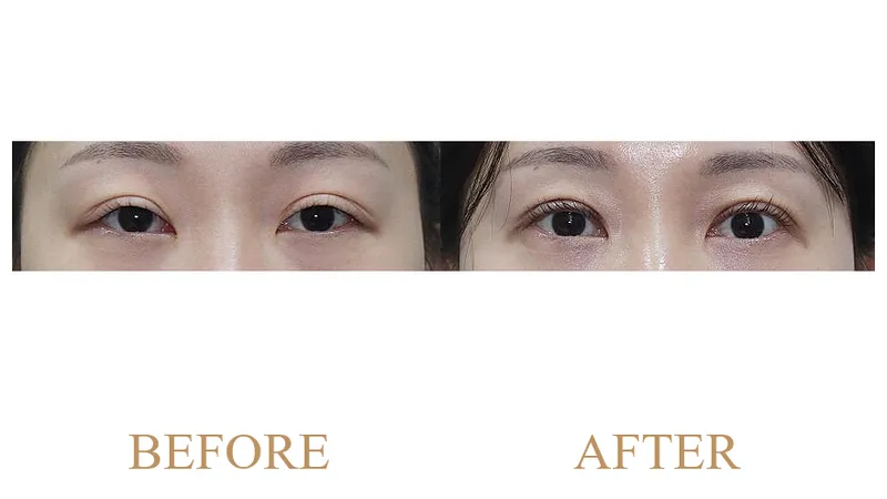 Revision Double Eyelid Line Lowering