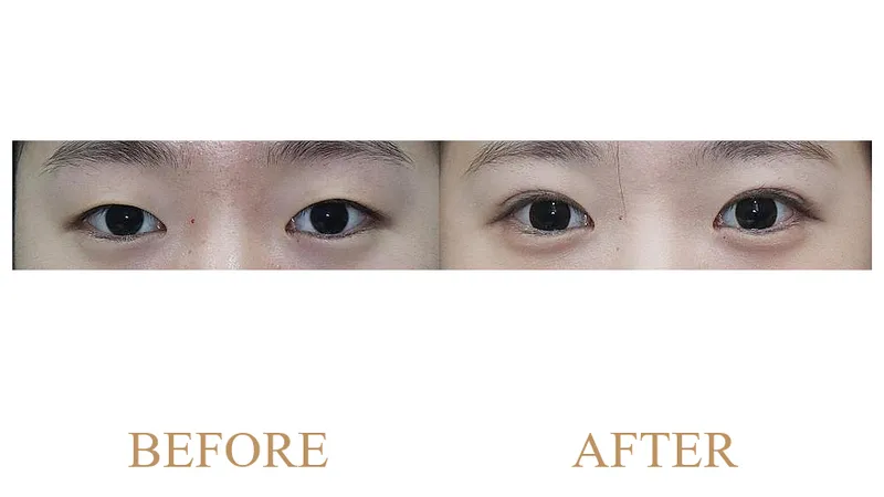Revision Natural Adhesion Double Eyelid Surgery + Ptosis Correction