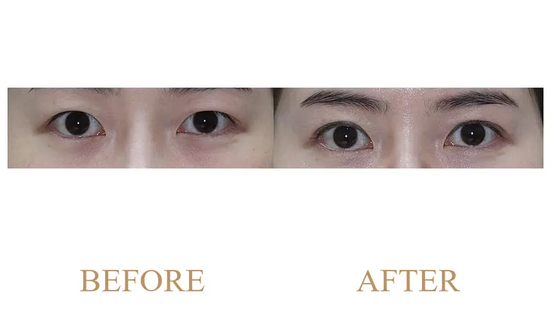 (Revision Surgery) Incisional Double Eyelid Surgery