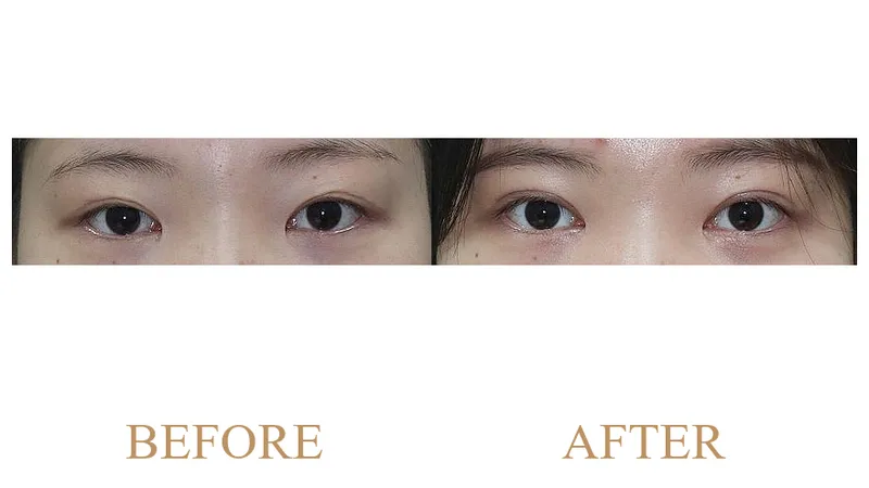 Revision Incisional Double Eyelid Surgery + Ptosis Correction + Under-Eye Fat Repositioning