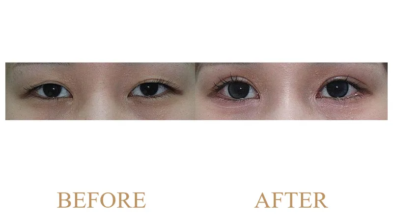 Revision Surgery-Incisional Double Eyelid Surgery, Ptosis Correction, Frontalis Muscle, Dual Thread