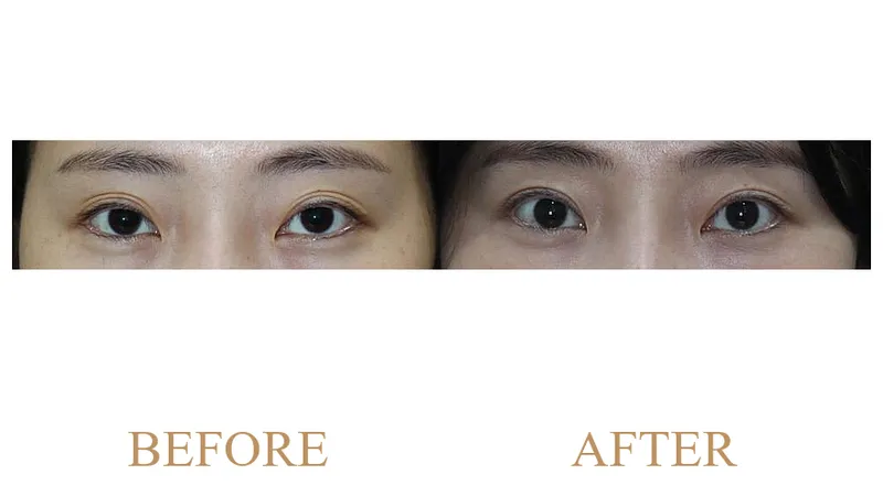 (Revision Surgery) Partial Incisional Double Eyelid Surgery + Ptosis Correction