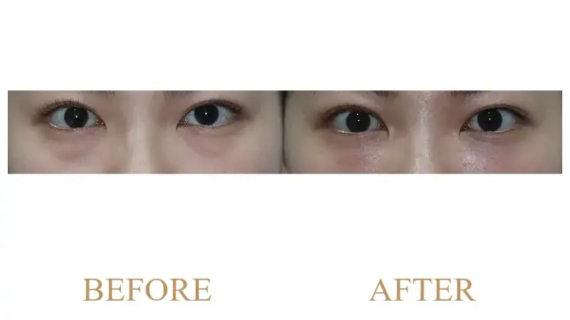 Under-Eye Fat Repositioning + Micro Fat Grafting + Double Eyelid Surgery