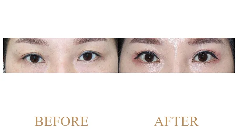 Upper Blepharoplasty (Incisional) + Ptosis Correction + Dual Epicanthoplasty