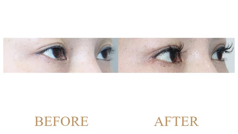 Upper Blepharoplasty (Incisional) + Ptosis Correction + Dual Epicanthoplasty