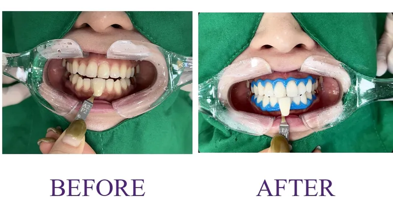 Professional Teeth Whitening