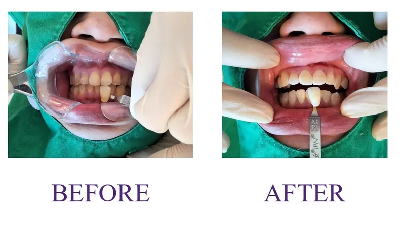 Teeth whitening