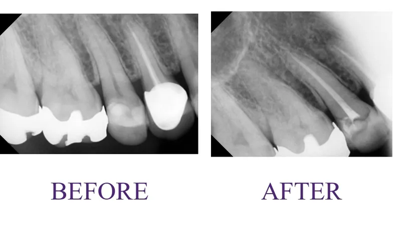 Root Canal Treatment