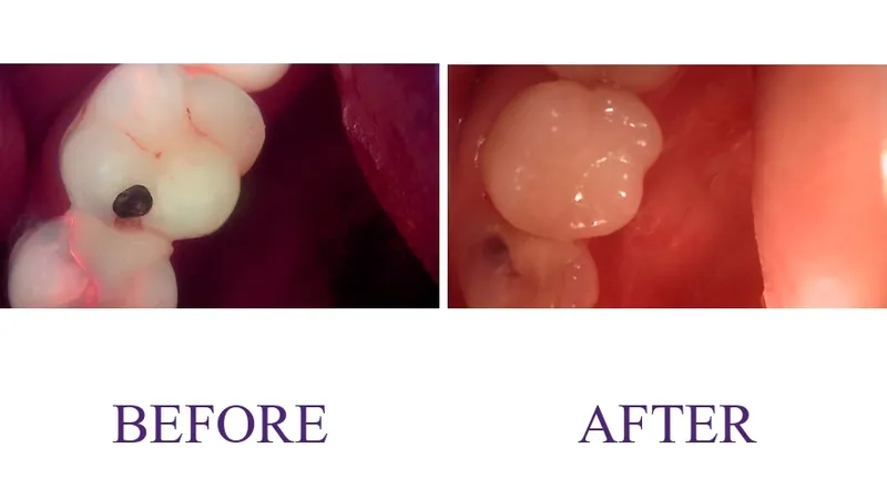 Resin restoration