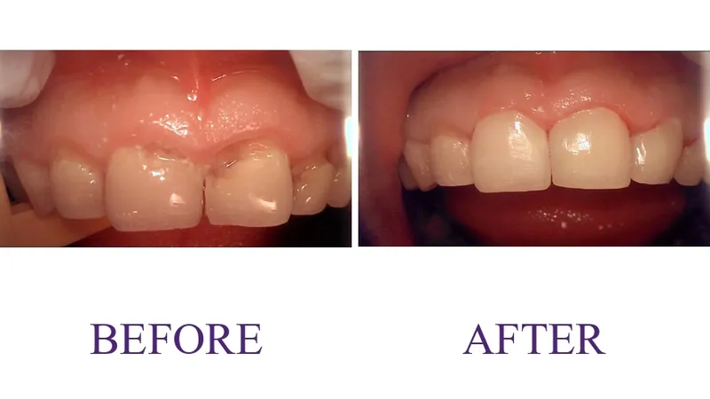 Anterior Resin
