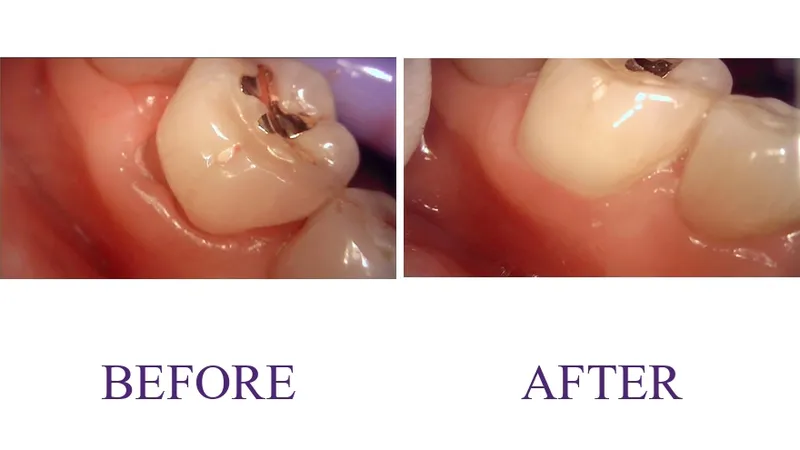 Cervical abrasion resin restoration
