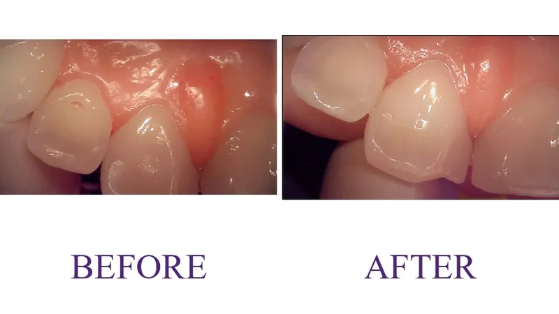 Resin caries treatment
