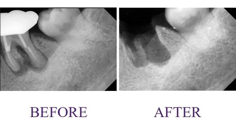 Previously RCT treated tooth with root fracture Surgical extraction
