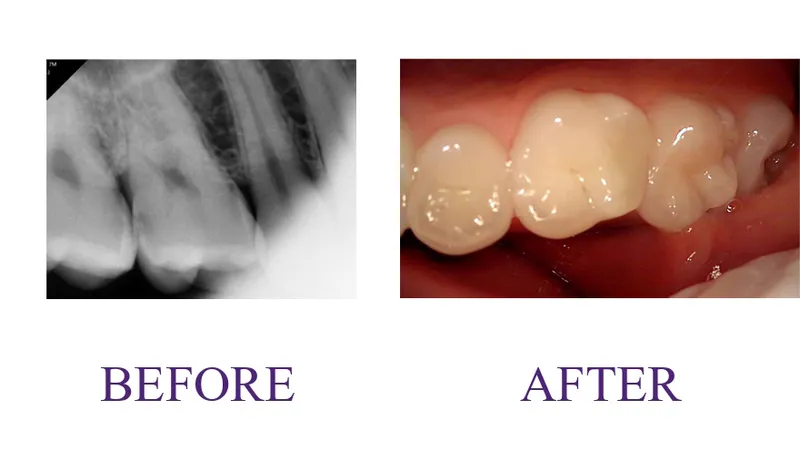 Resin restoration