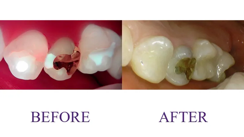 Resin restoration
