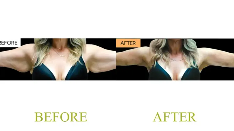 Arm/Underarm Area: Renuvion Tightening